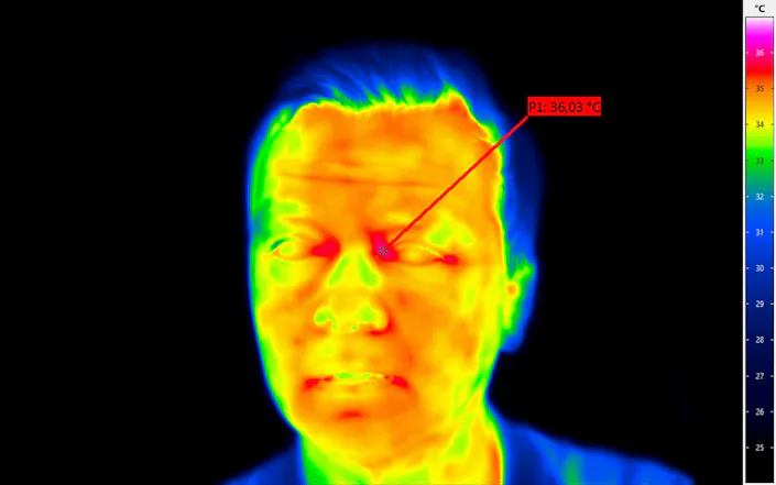 Thermografie in der Humanmedizin mit Wärmebildkamera VarioCAM® HDx head S